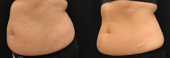 emsculpt-body-contouring-castle-rock-co-big-0